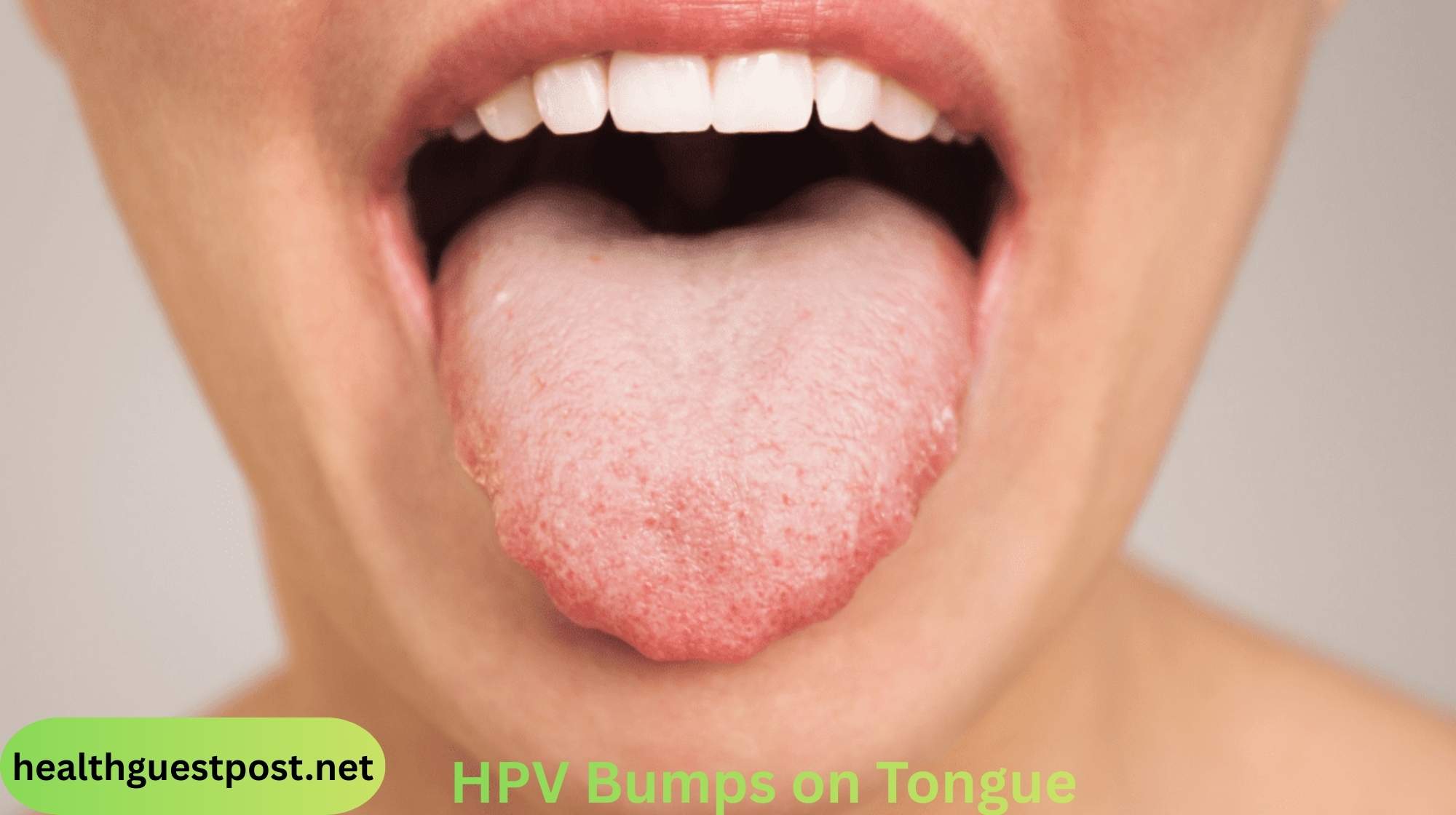  HPV Bumps on Tongue: Understanding Its Causes, Types, and Treatment