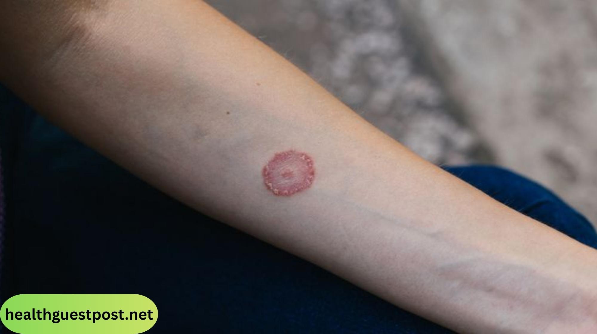 Red circle on skin not ringworm? Here’s when to visit the ER of Irving