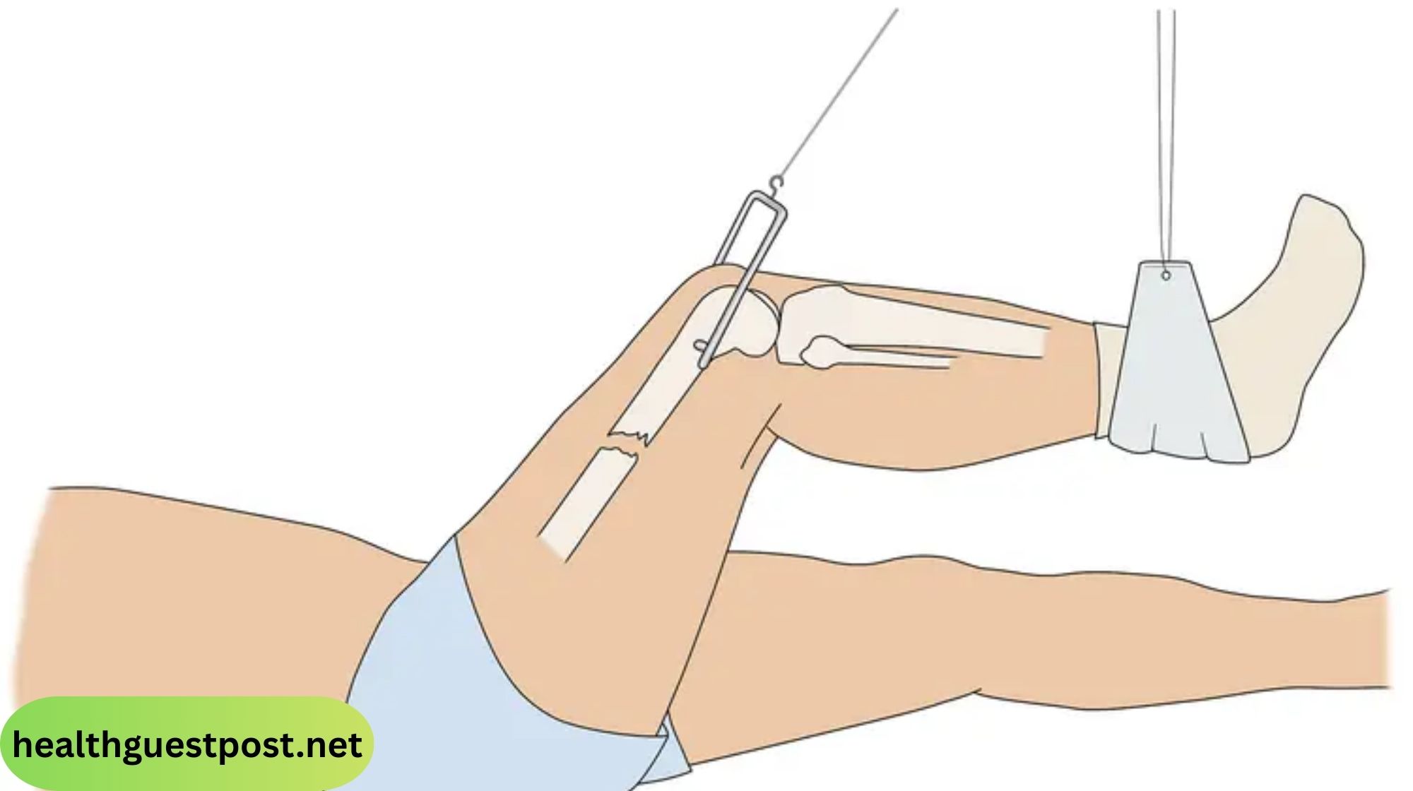 Skeletal Traction: Procedure, Uses, and Recovery Plan