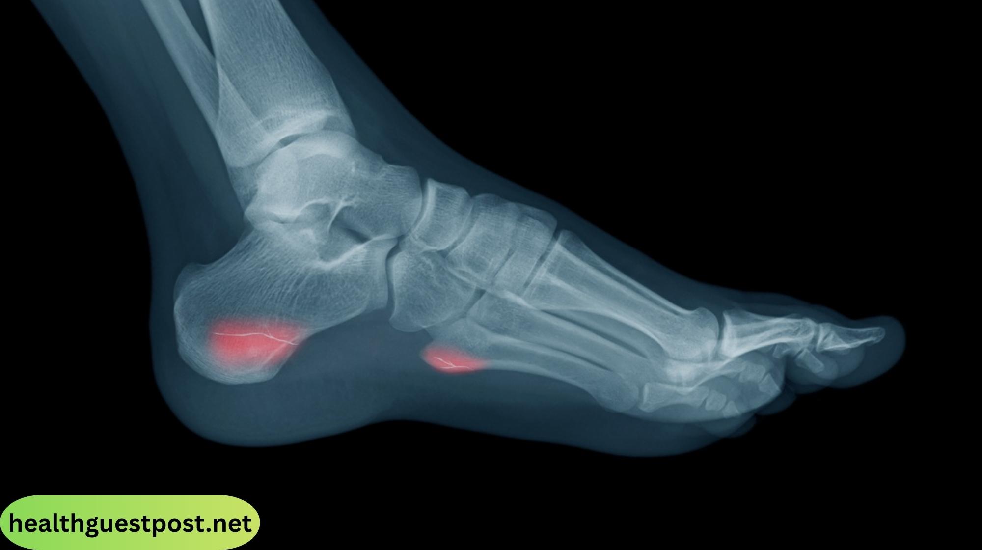 What Does a Stress Fracture Feel Like? Symptoms, Causes, and Treatment