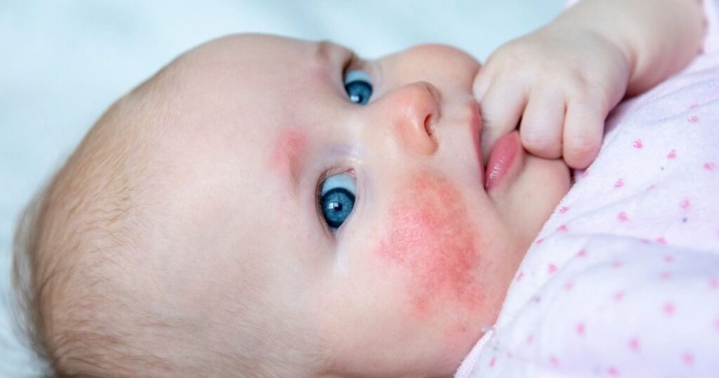 Red Circle on Skin in Children and Babies