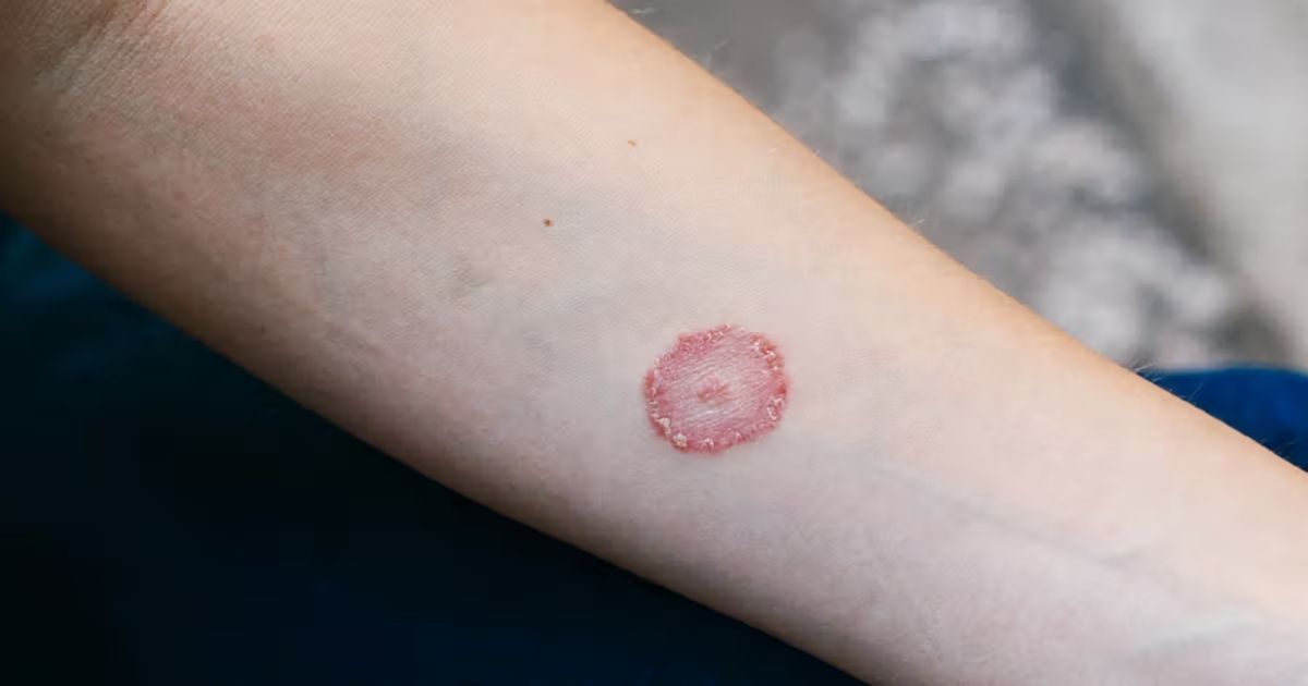 Red Circle on Skin: Causes, Treatments, and When to Worry
