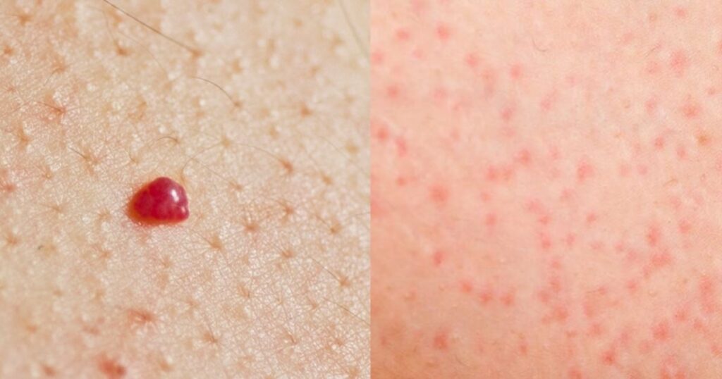 What Causes a Red Circle on Skin