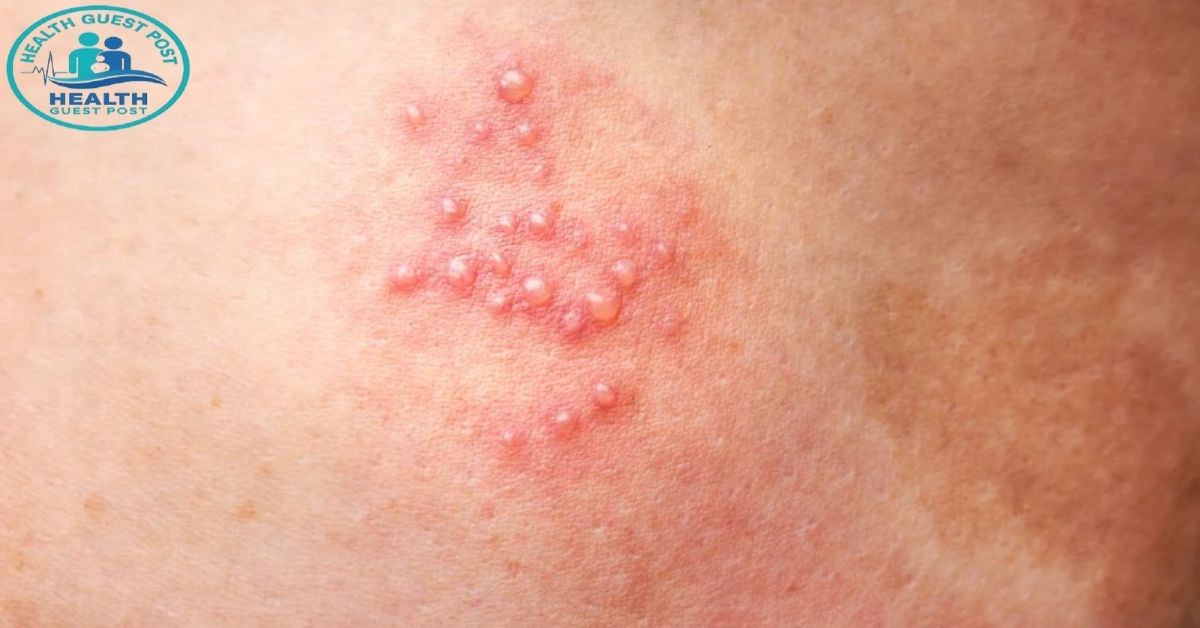 What are STD bumps? How do they look like?